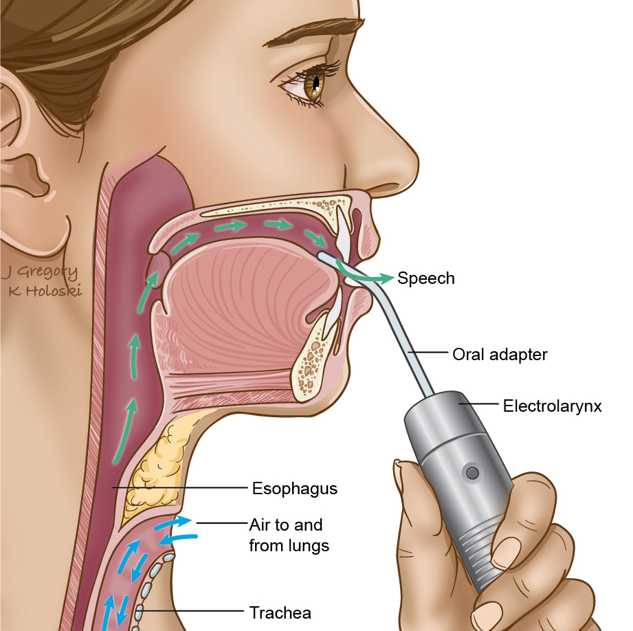 Laryngeal Cancer Surgery